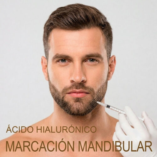 Marcación Mandibular con Ácido Hialurónico en Sevilla